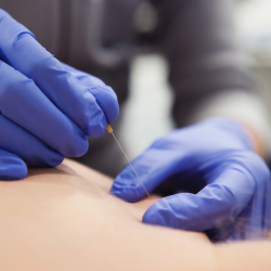 dry needling Rembrandt Fysiotherapie & Revalidatie Veenendaal Rhenen Amerongen Duiven Lienden hoofd- & kaakfysio