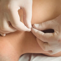 Patiënt zonder shirt wordt door de fysiotherapeut met handschoenen aan behandeld middels dry needling in Duiven