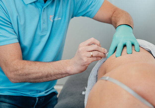 patient krijgt een dry needling in Veenendaal behandeling